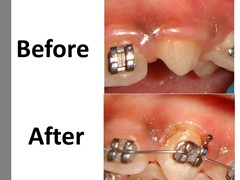 Best dental implant centre in bhopal